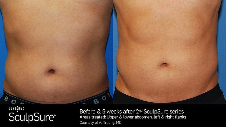 sculpsure before after for abdominal
